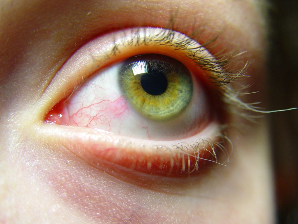severe dry eye