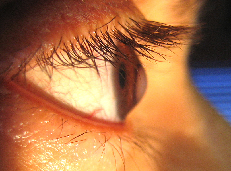 Keratoconus
