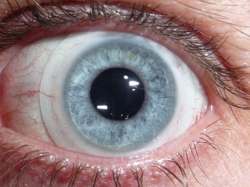 Scleral Lenses