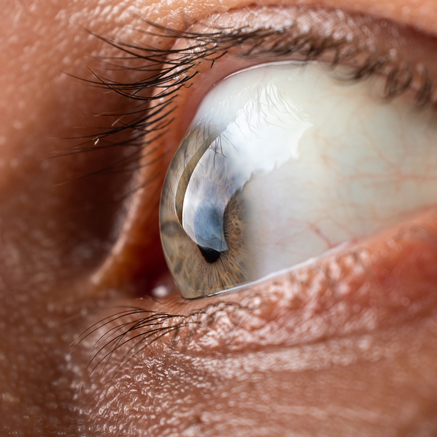 Keratoconus